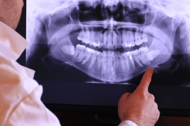Best Emergency Wisdom Tooth Extraction in Fair Oaks, GA